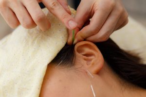 耳の鍼治療